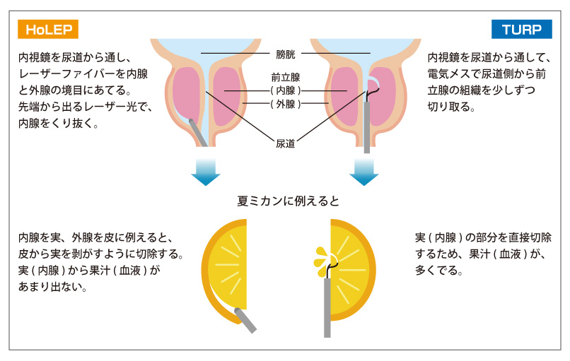 HoLEP：内視鏡を尿道から通し、レーザーファイバーを内腺と外腺の境目にあてる。先端から出るレーザー光で、内腺をくり抜く。夏ミカンに例えると、内腺は実、外腺は皮にあたり、皮から実を剥がすように切除する。実(内腺)から果汁(血液)があまり出ない。TURP：内視鏡を尿道から通して、電気メスで尿道側から前立腺の組織を少しずつ切り取る。夏ミカンに例えると、実(内腺)の部分を直接切除するため、果汁(血液)が、多く出る。