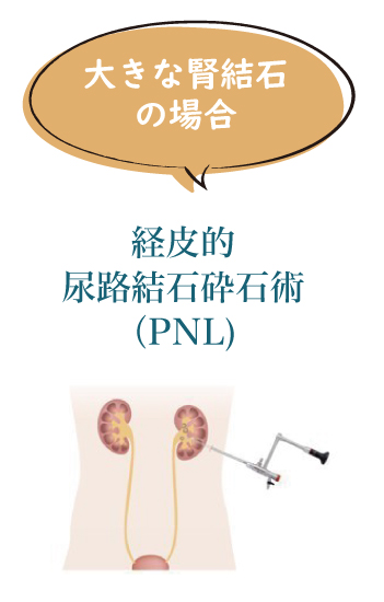 大きな腎結石の場合　経皮的尿路結石砕石術（PNL）